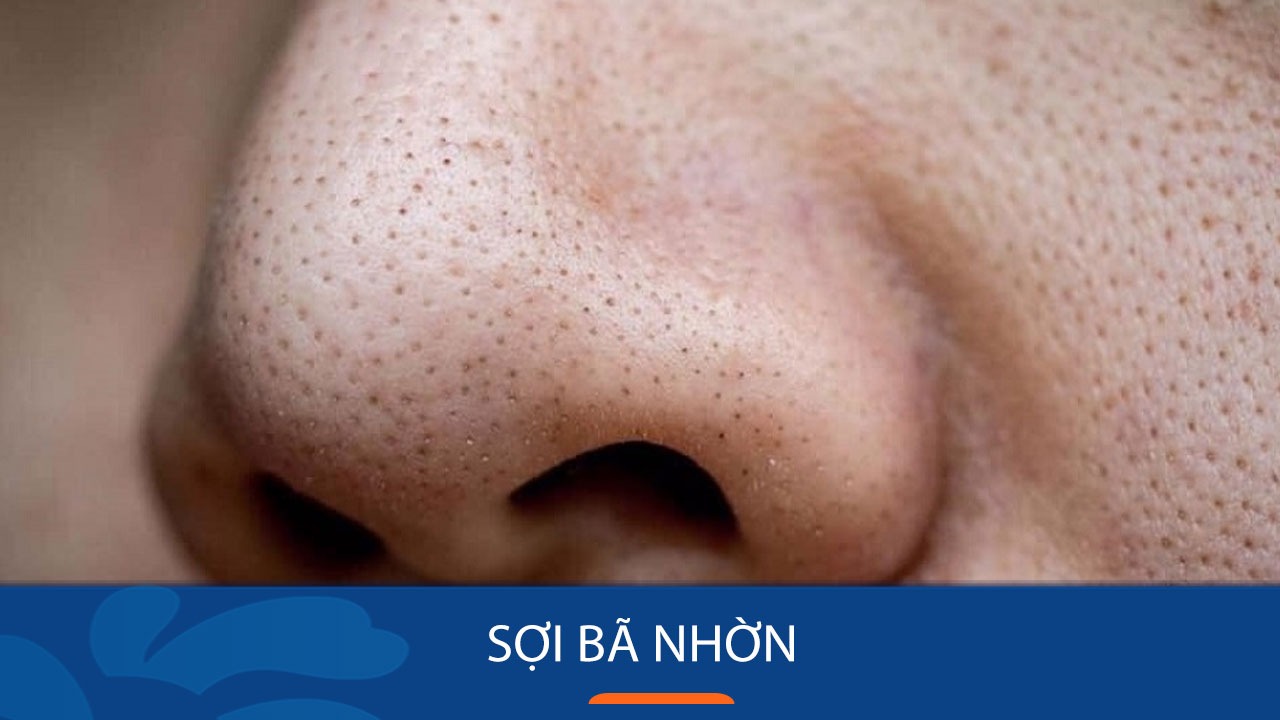 4 nguyen nhan gay soi ba nhon